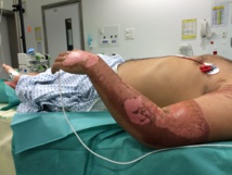 Catalepsie sur un patient au service des grands brûlés Catalepsie sur un patient au service des grands brûlés