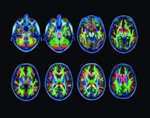 Hypnoscope Avril 2015 - Actualités Therapeutiques Hypnoscope Avril 2015 - Actualités Therapeutiques